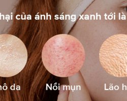 MÀN HÌNH MÁY TÍNH, ĐIỆN THOẠI VÀ NHỮNG TÁC HẠI VỚI LÀN DA