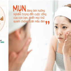 NGUYÊN NHÂN VÀ CÁCH CHĂM SÓC CHO DA MỤN TUỔI DẬY THÌ